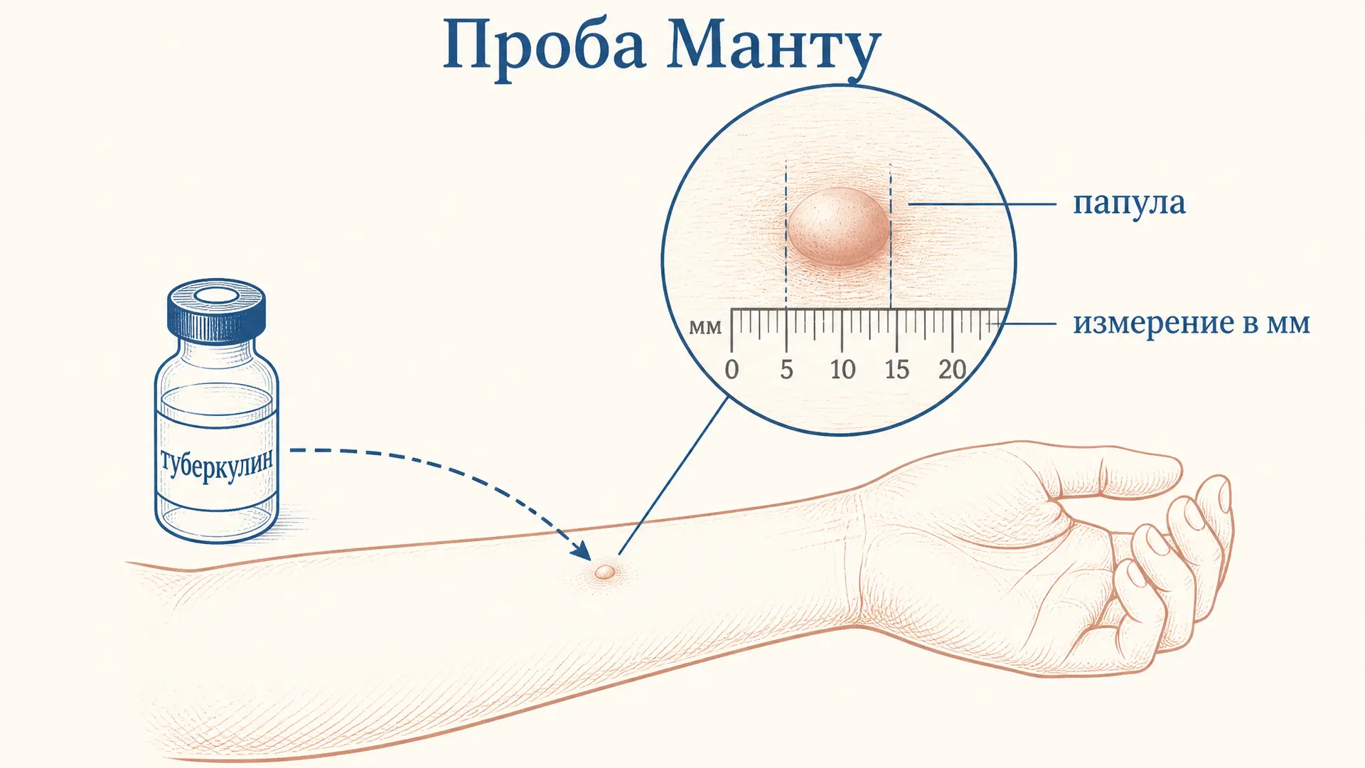 Реакция Манту: туберкулиновая проба и оценка результата