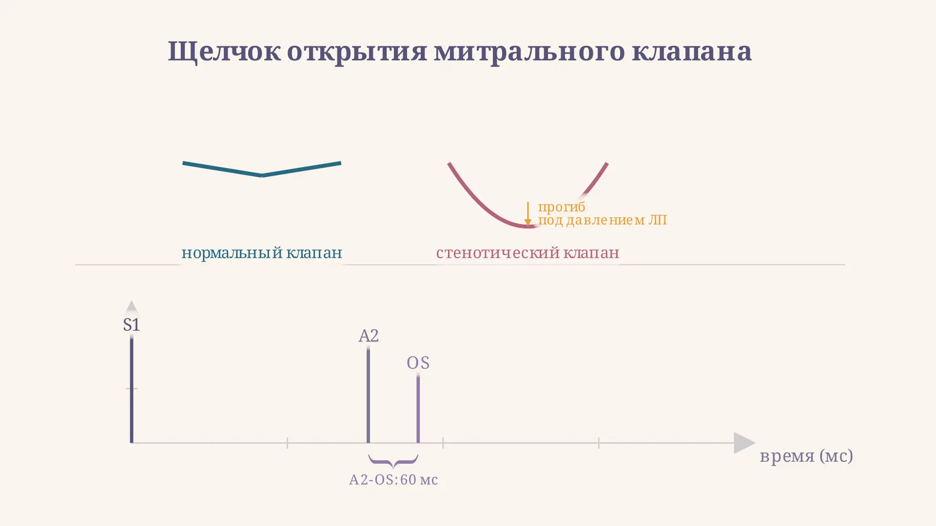 Щелчок открытия митрального клапана: A2-OS и стеноз