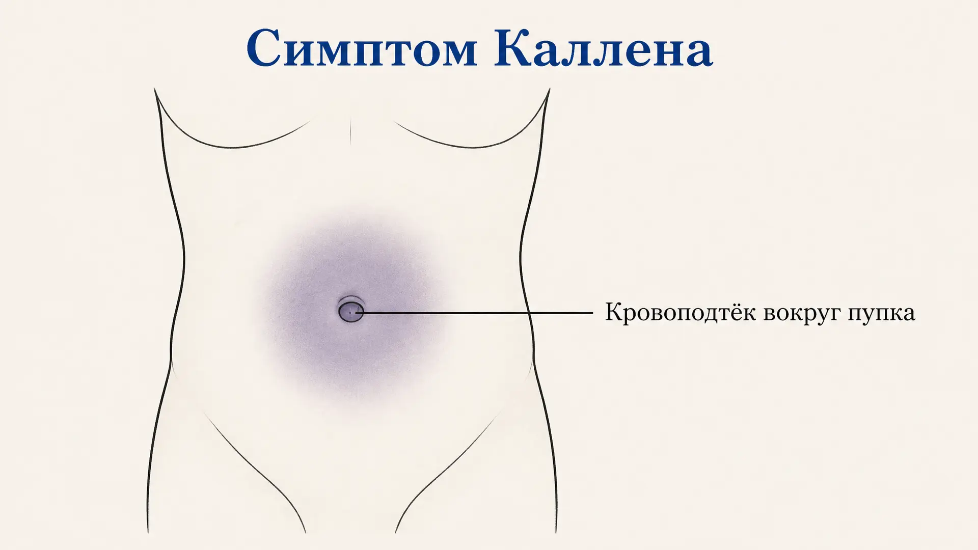 Симптом Каллена: что значит синяк вокруг пупка