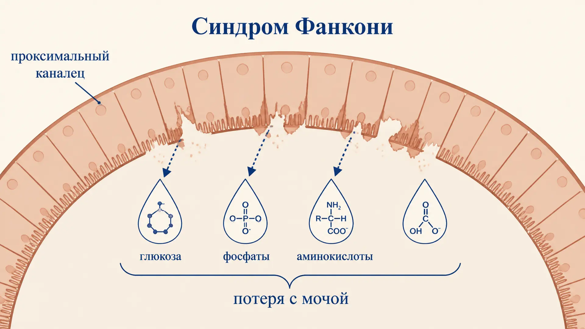 Синдром Фанкони: дисфункция проксимального канальца почки