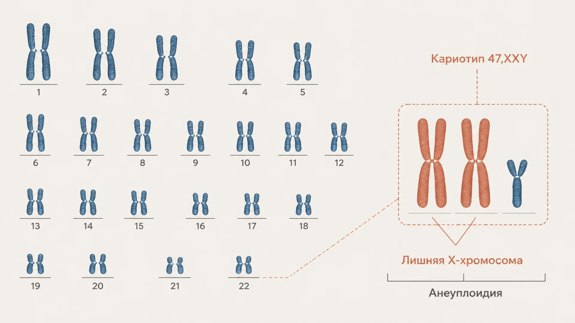 Синдром Клайнфельтера: кариотип 47,XXY