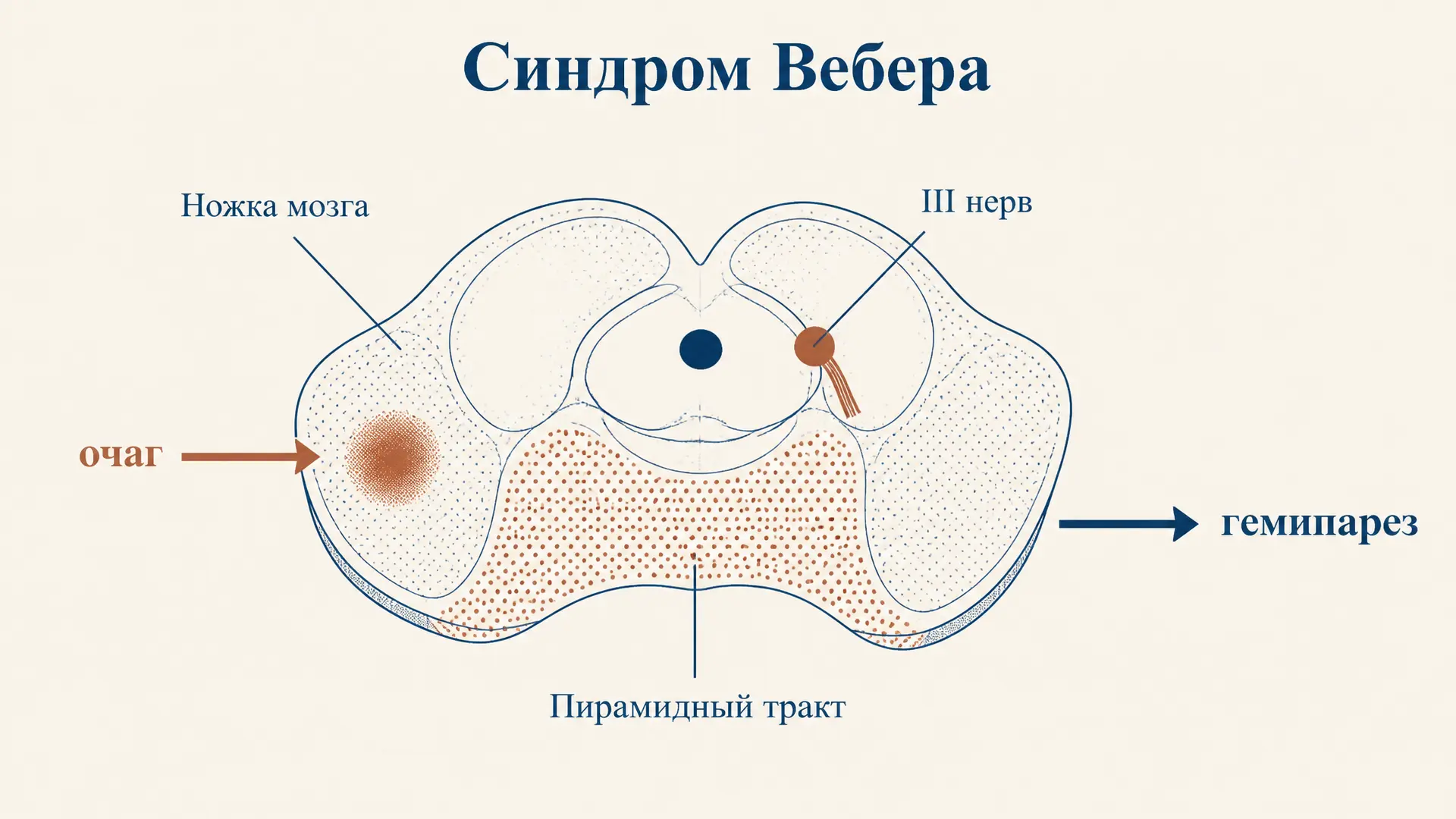 Синдром Вебера: поражение ножки мозга и его клиника