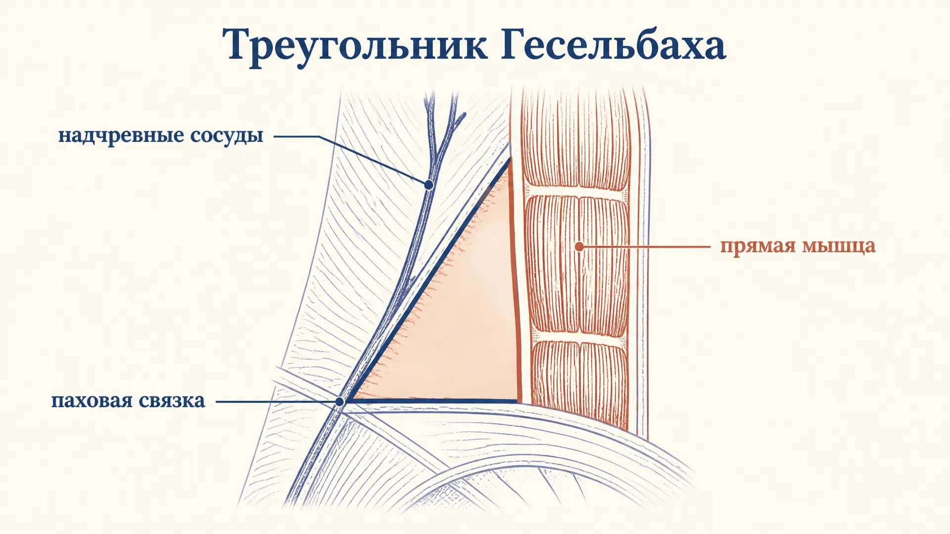 Треугольник Гесельбаха: границы и грыжи