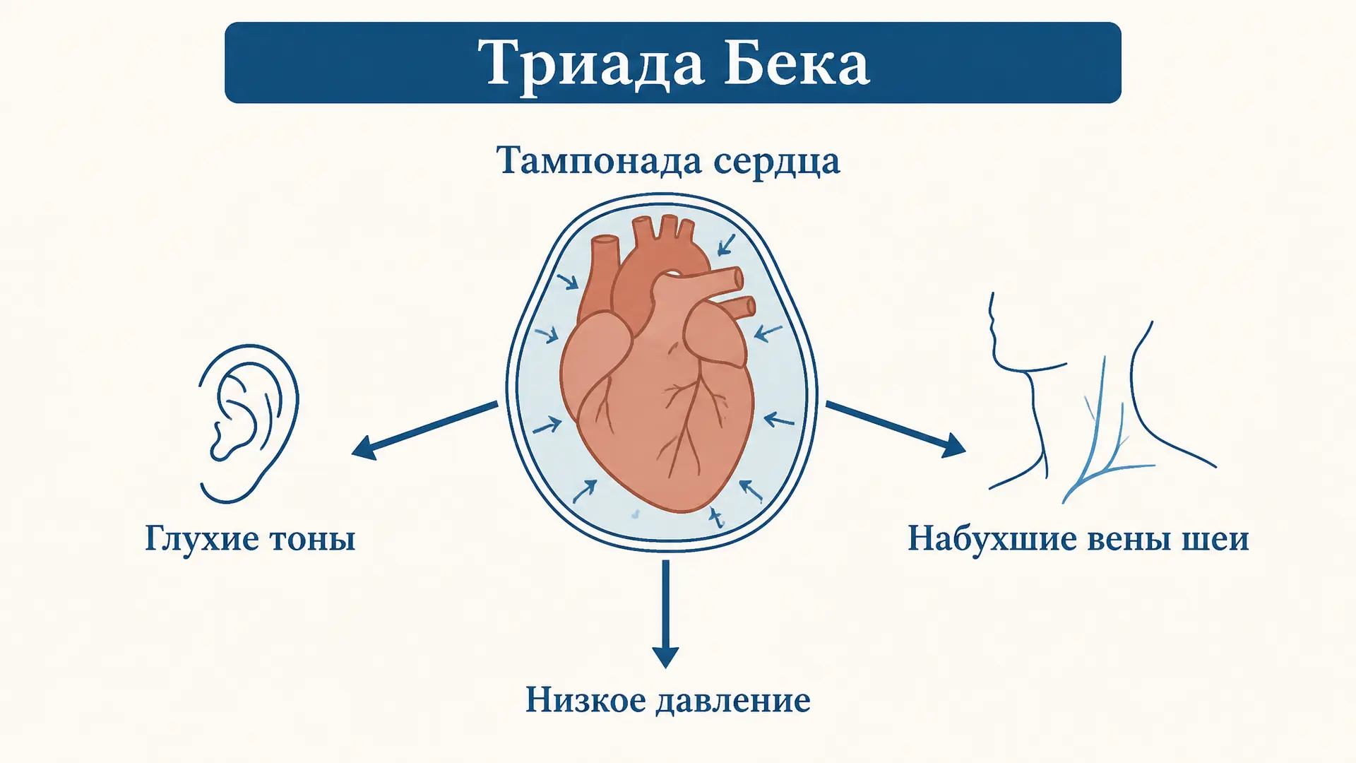 Триада Бека: три признака тампонады сердца
