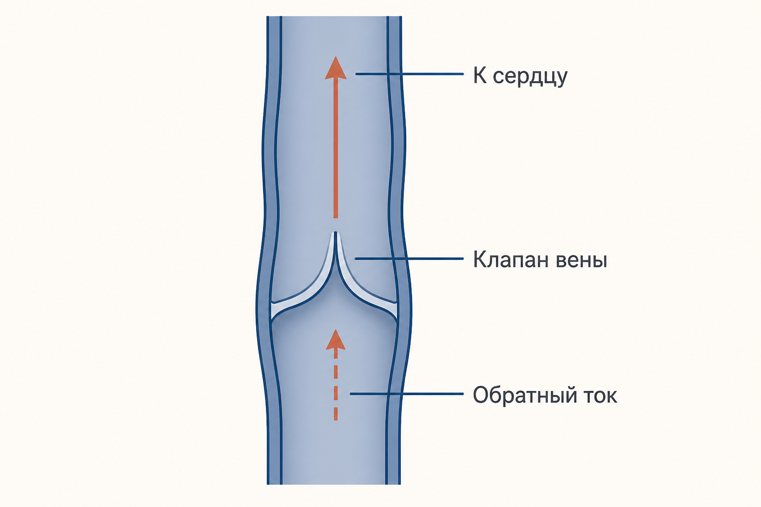Схема венозного клапана: створки направляют поток к сердцу и препятствуют обратному току в вене конечности
