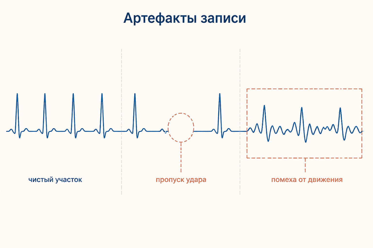 Три зоны записи ритма: ровный чистый участок, место с пропущенным ударом в пунктирном круге и зашумлённый участок в пунктирной рамке